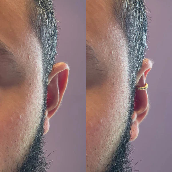 Earfix - Διορθωτής Αυτιών για Φυσικό Αποτέλεσμα